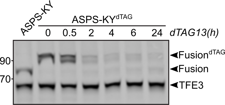 Alveolar Soft Part Sarcoma cells 