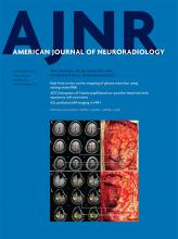 Angioarchitectures and Hemodynamic Characteristics of Posterior Communicating Artery Aneurysms and Their Association with Rupture Status