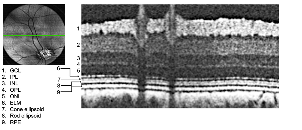 Fundus Photo