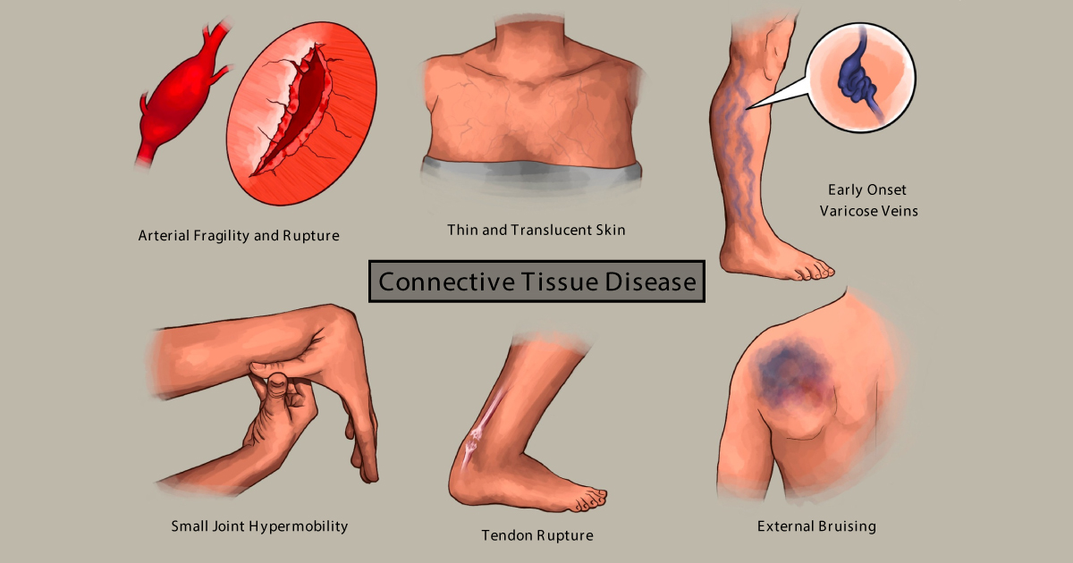 connective tissue disease characteristics