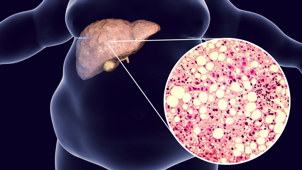 Fatty Liver Disease and Diabetes