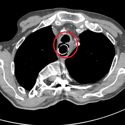 TEF GI Procedures