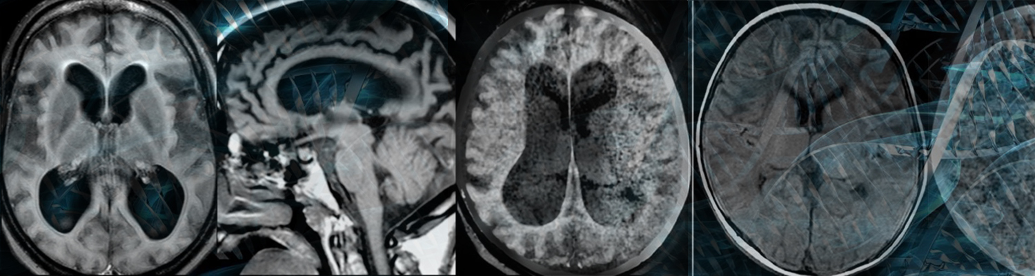 Dr. Miguel Sena-Esteves from the Esteves Lab (Horae Gene Therapy Center) is conducting research and developing therapeutic strategies for rare inherited diseases such as the Tay-Sachs disease