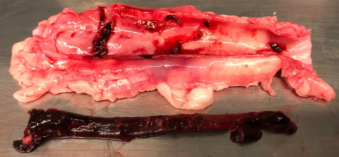 Thrombi characterization