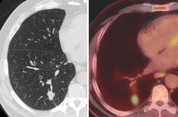 LDCT Lung Screening 1