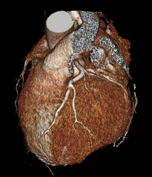 Heart CT