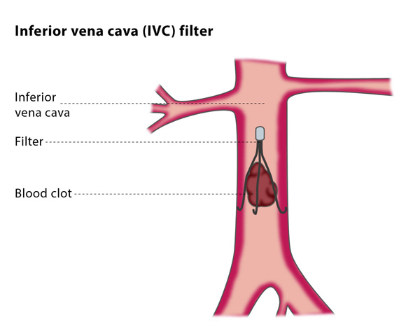 ivc filter