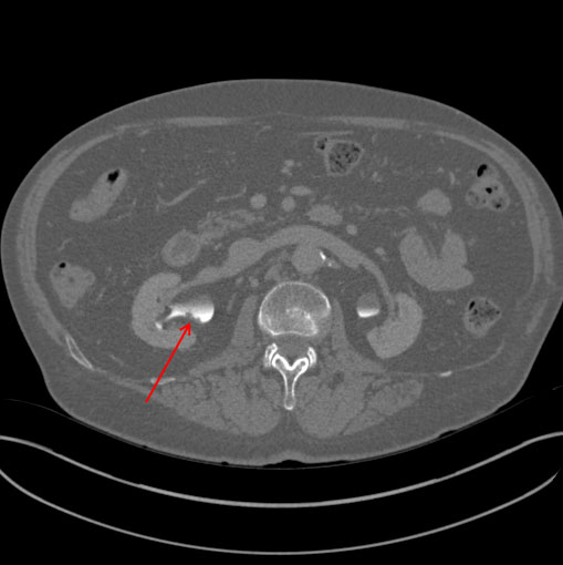 Renal CT - Department of Radiology UMass Chan Medical School