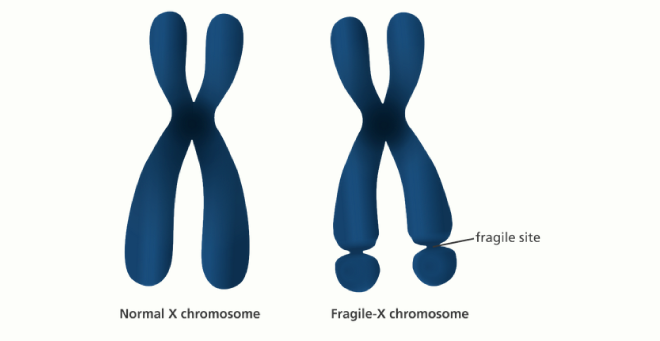 Antisense therapy restores fragile X protein production in human cells