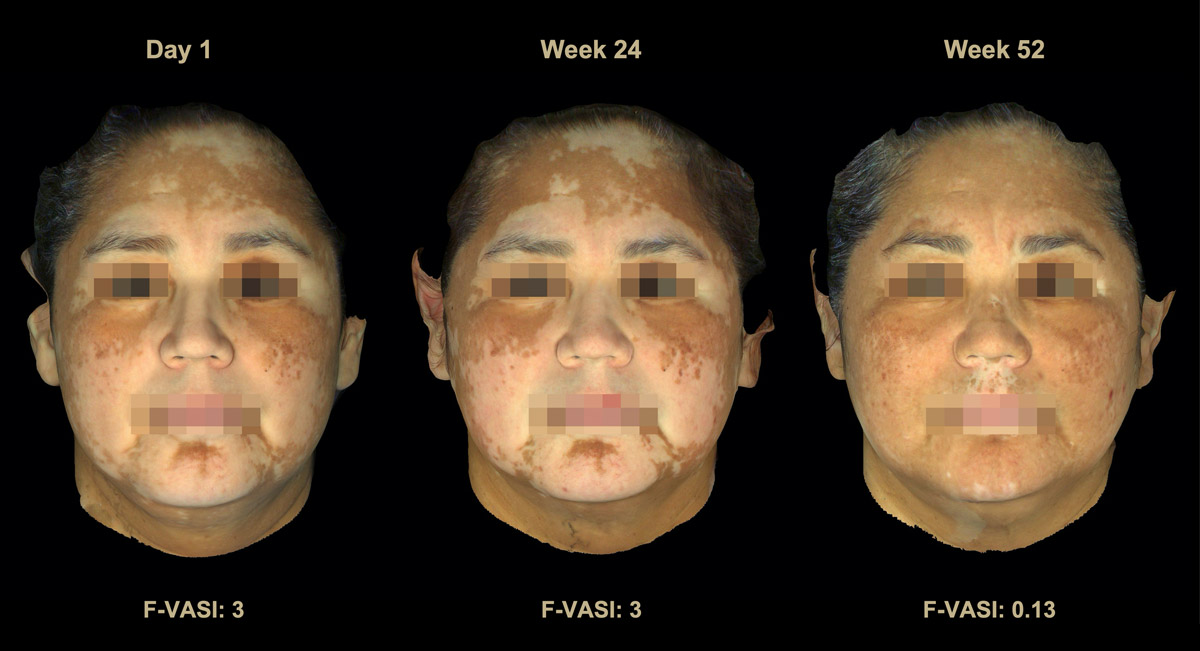 Incyte-topical-ruxolitinib-phase-III.jpg