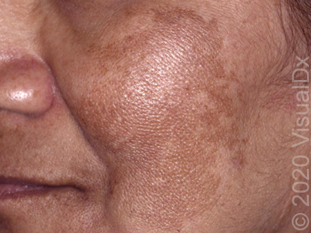 Melasma_105271.jpg