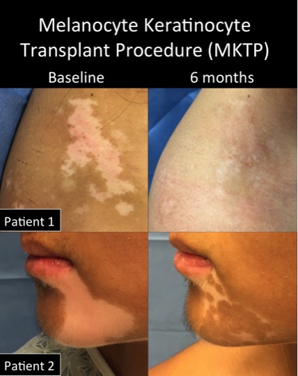 MKTP before-after