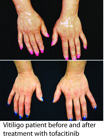 Tofacitinib treatment of vitiligo